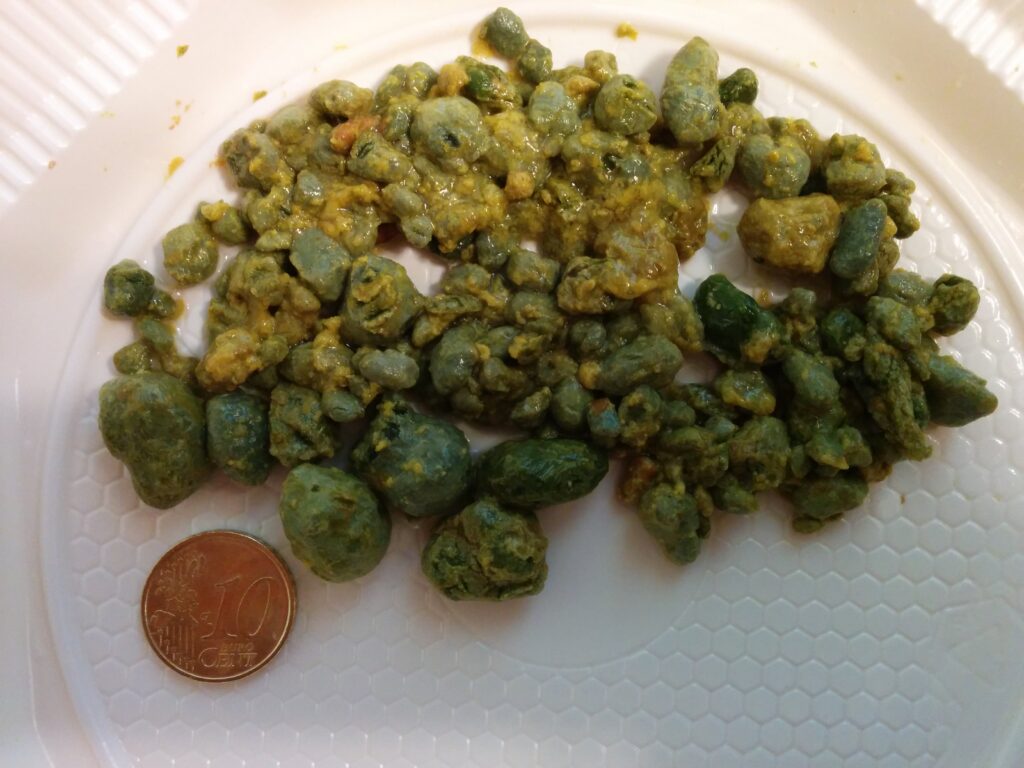 Gallbladder stones